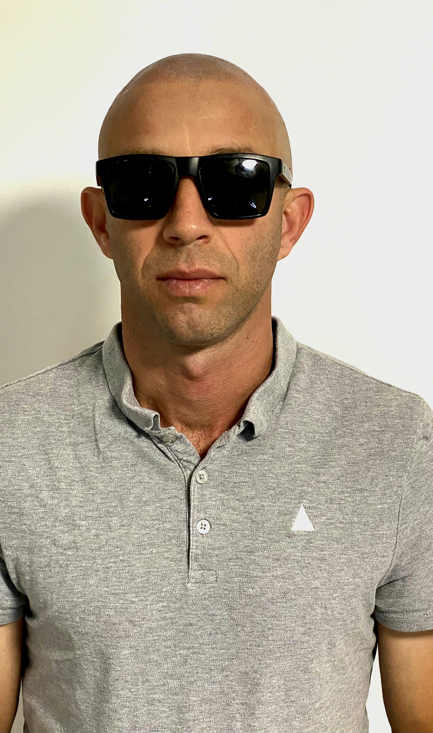 Scar Camouflage Alopecia SMP Brisbane