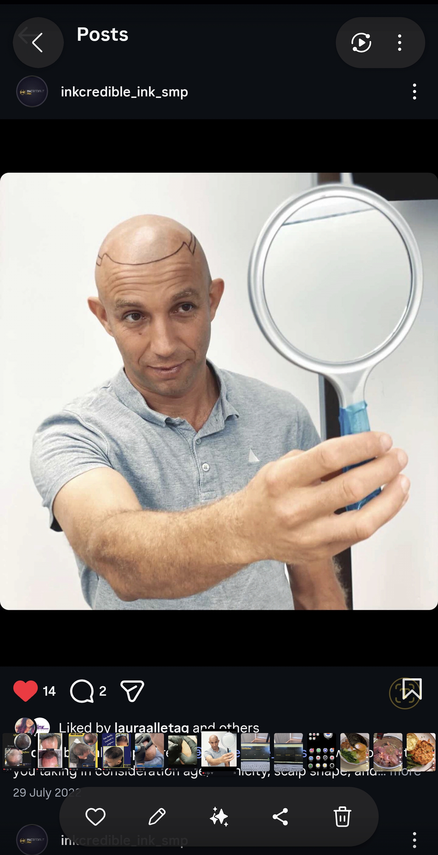 Scalp Micropigmentation Brisbane